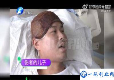 男子瞒着烧伤父亲“割皮救父”,全村人自发捐款8000多元！！！