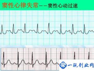 窦性心律不齐是心脏病早期吗(窦性心律不齐需要治疗吗)