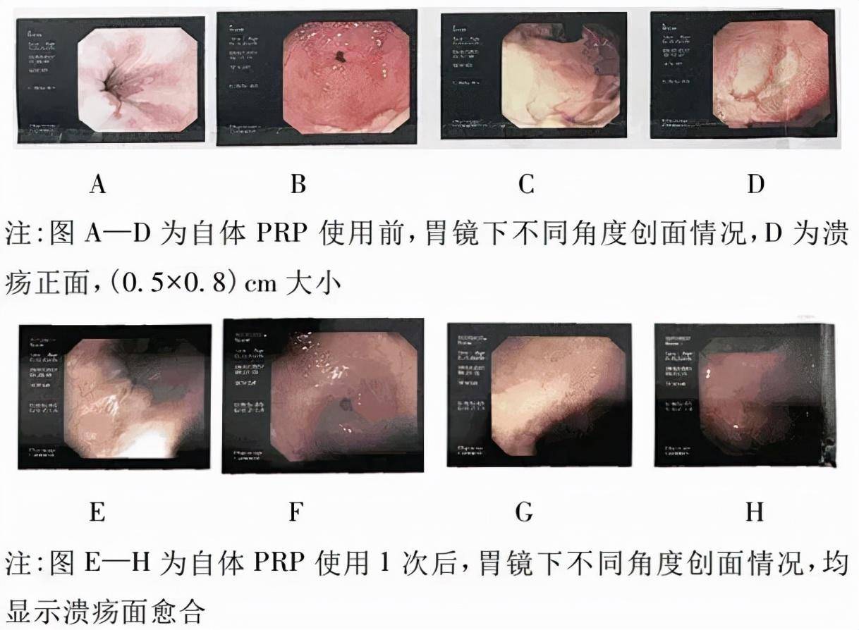 pdgf医学是什么意思(生长因子可以修复疤痕吗)