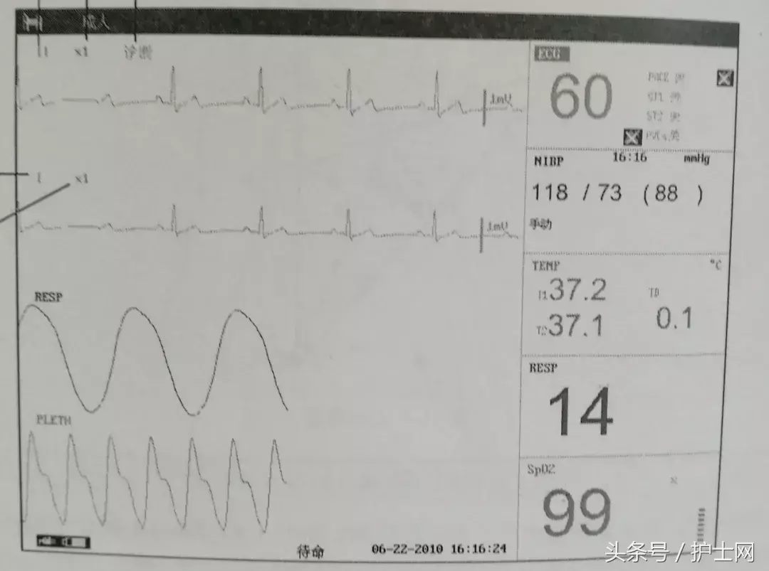心电监护仪上的详细图解(如何看监护仪上的参数)