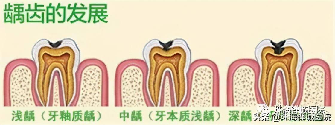 蛀牙如何让它停止腐蚀(种植牙收费价目表)