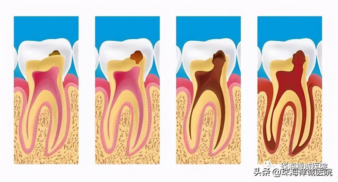 蛀牙如何让它停止腐蚀(种植牙收费价目表)