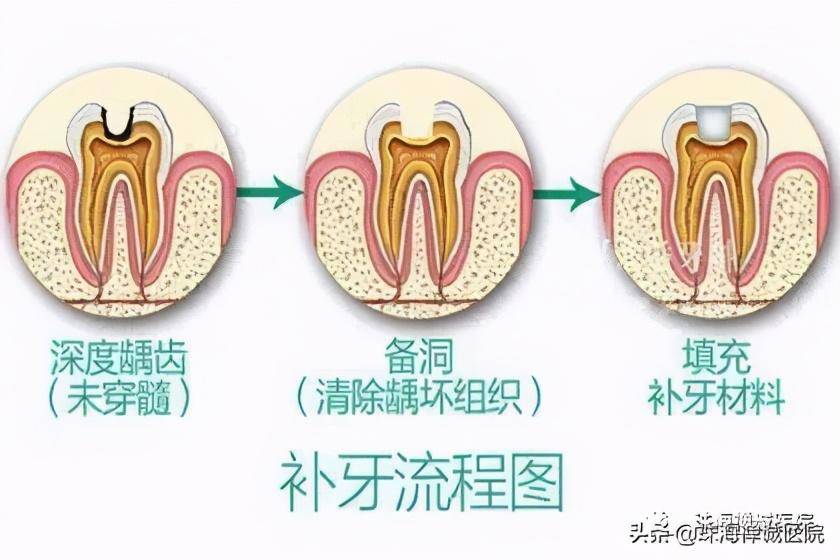 蛀牙如何让它停止腐蚀(种植牙收费价目表)