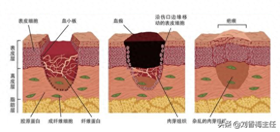 伤口痒是长肉还是感染(伤口痒是不是代表快好了)