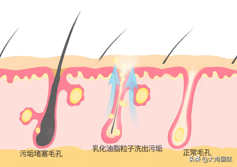 毛孔堵塞怎样清理(疏通毛孔堵塞最有效的方法)