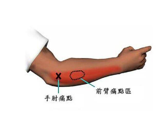 网球手的治疗方法(网球肘该如何治疗)